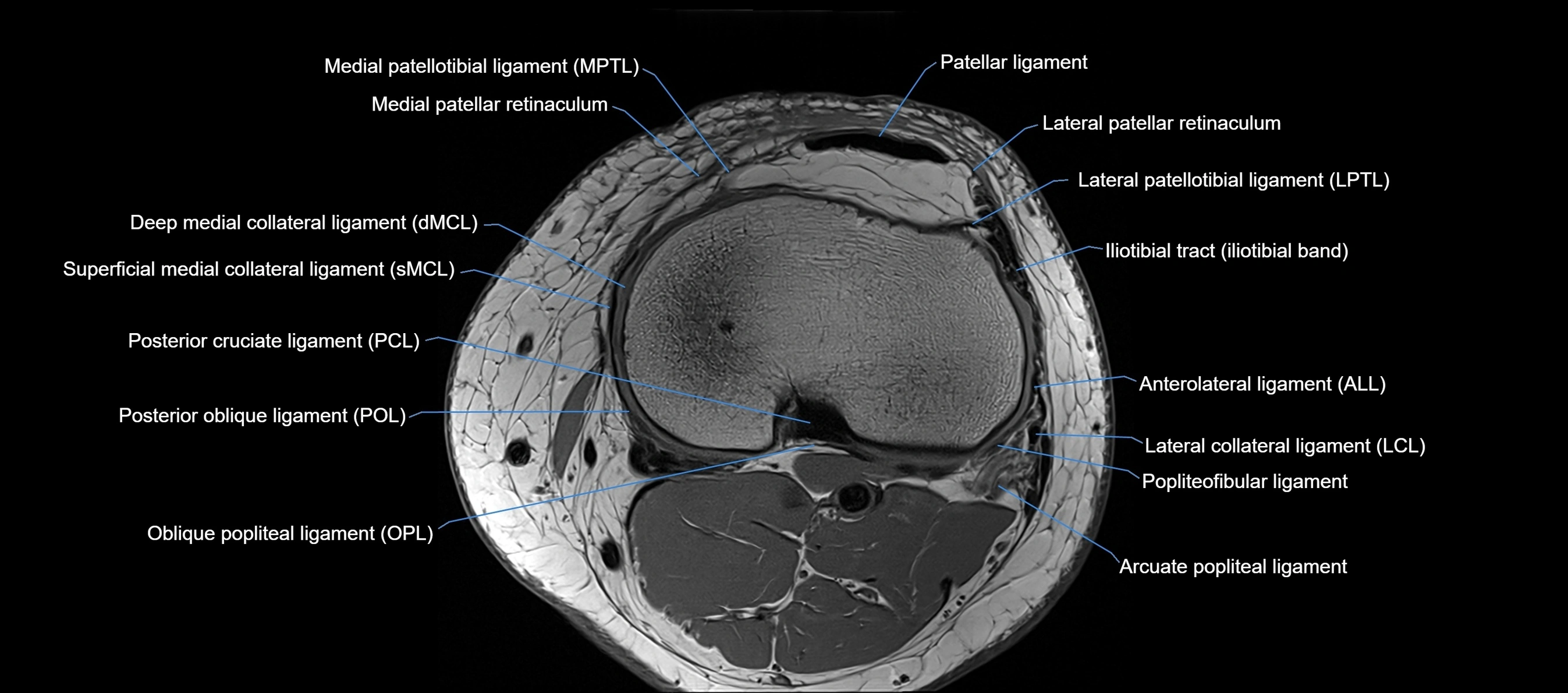 MRI Knee axial  ligaments cross sectional anatomy 3T  radiology  image-img-03001-00033.webp